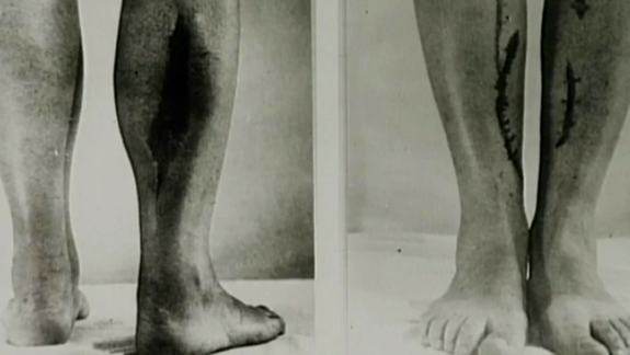 Schwarz-weiß Foto von zwei paar Beinen mit Verletzungen